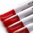 Transmiterea virusului HIV poate fi prevenită