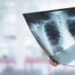 Radiografie a plămânilor. Foto sfatulmedicului.ro